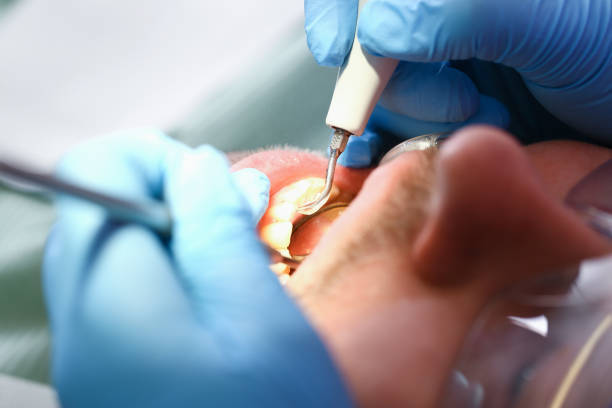 Best Emergency Wisdom Teeth Removal in Kings Bay Base, GA